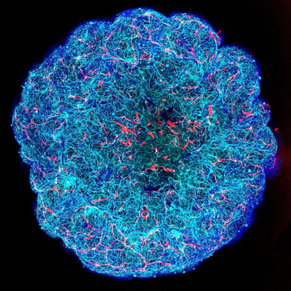 Model tredimensional miBrain i përdorur në kërkimin mbi APOE4 dhe Alzheimerin.